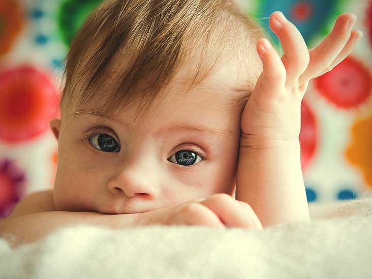 Yeni Doğan Bebekte Down Sendromu Nasıl Anlaşılır